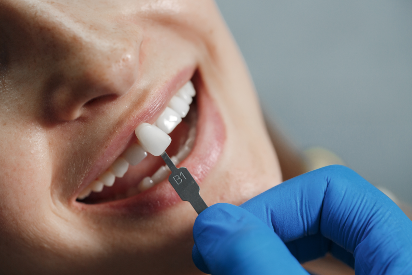 Diagrama de un implante dental mostrando el poste de titanio, el pilar y la corona de porcelana — Fort Worth Dental