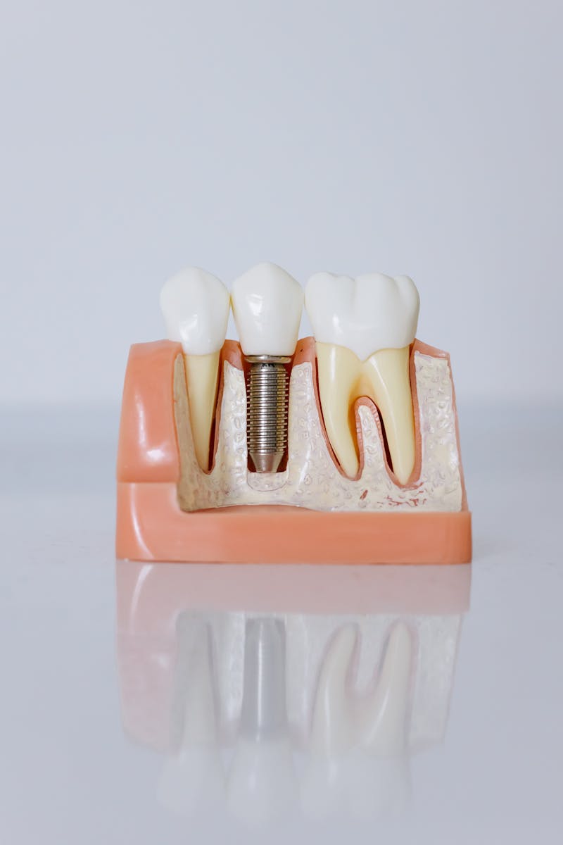 Why Ridge Augmentation